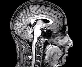 fMRI video thumbnail